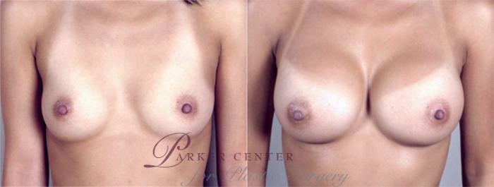 Breast Augmentation Case 369 Before & After View #1 | Paramus, NJ | Parker Center for Plastic Surgery