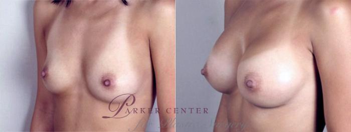 Breast Augmentation Case 369 Before & After View #2 | Paramus, NJ | Parker Center for Plastic Surgery