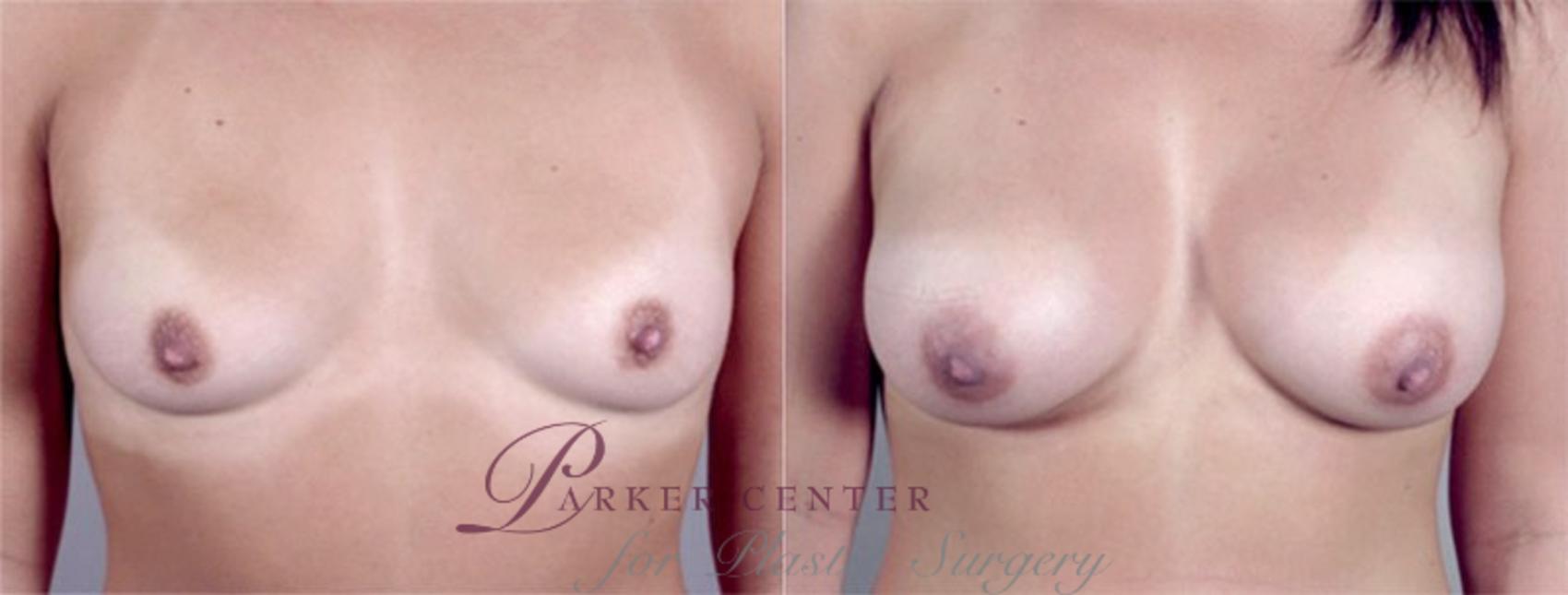 Breast Augmentation Case 370 Before & After View #1 | Paramus, NJ | Parker Center for Plastic Surgery