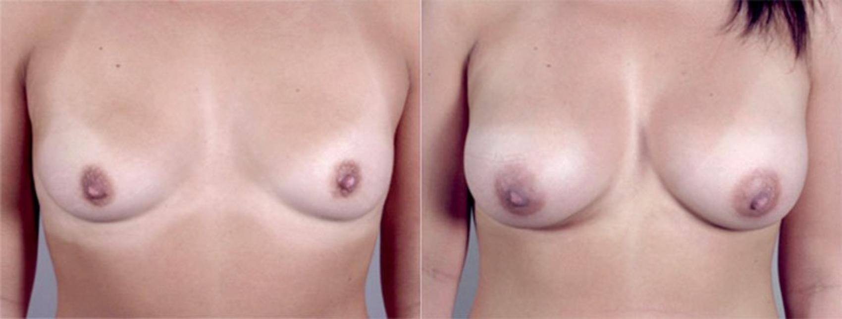 Breast Augmentation Case 370 Before & After View #1 | Paramus, NJ | Parker Center for Plastic Surgery