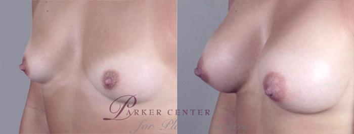 Breast Augmentation Case 370 Before & After View #2 | Paramus, NJ | Parker Center for Plastic Surgery