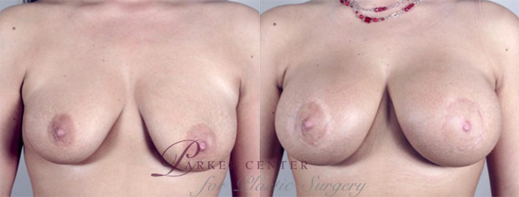 Breast Augmentation Case 371 Before & After View #1 | Paramus, NJ | Parker Center for Plastic Surgery