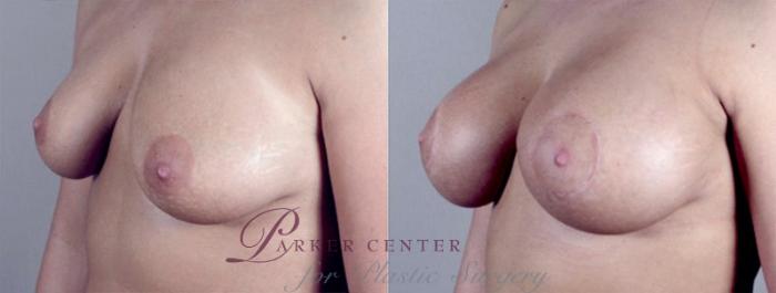 Breast Augmentation Case 371 Before & After View #2 | Paramus, NJ | Parker Center for Plastic Surgery