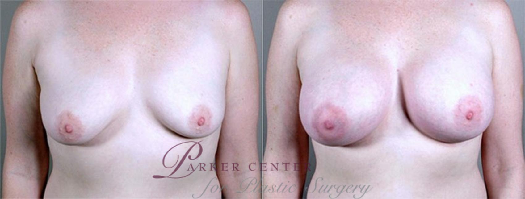 Breast Augmentation Case 372 Before & After View #1 | Paramus, NJ | Parker Center for Plastic Surgery