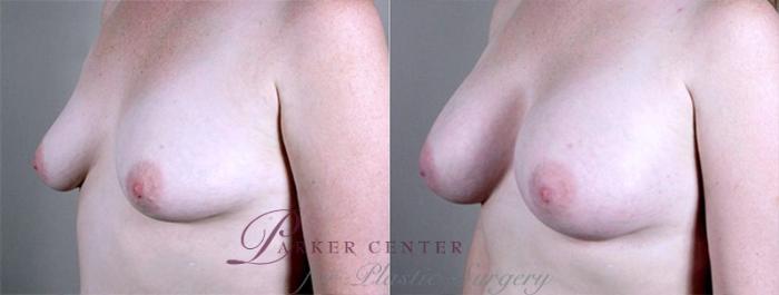 Breast Augmentation Case 372 Before & After View #2 | Paramus, NJ | Parker Center for Plastic Surgery