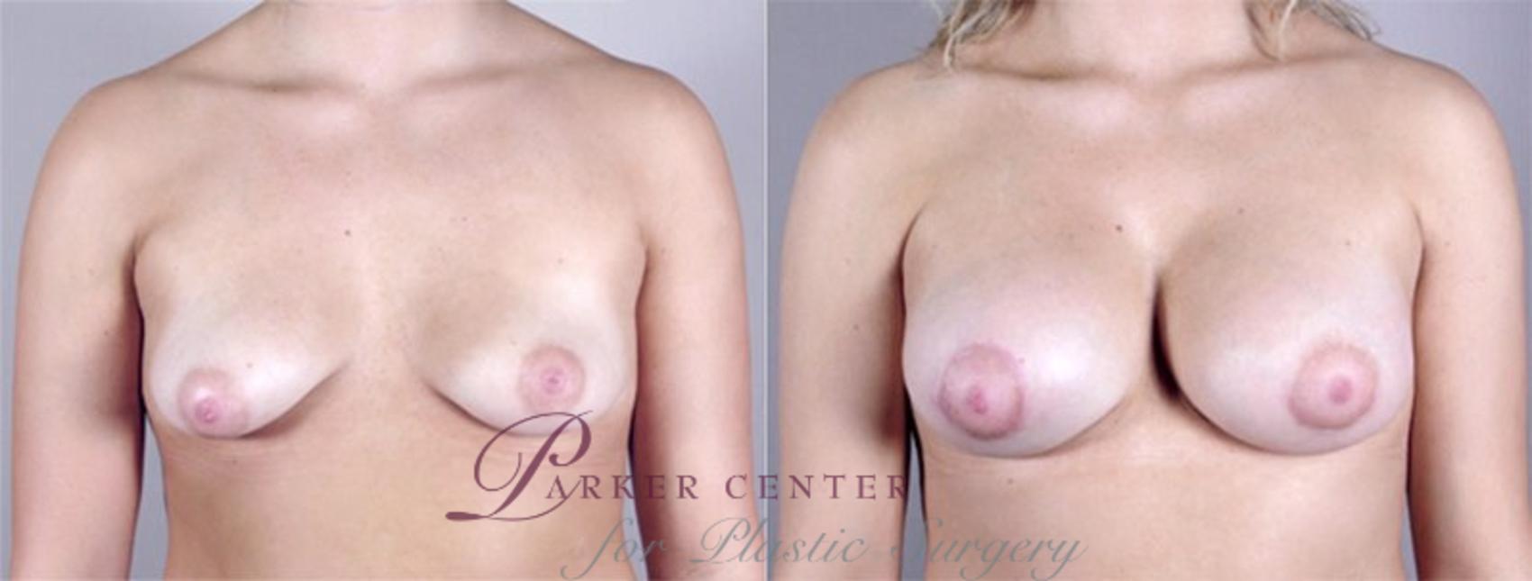 Breast Augmentation Case 373 Before & After View #1 | Paramus, NJ | Parker Center for Plastic Surgery