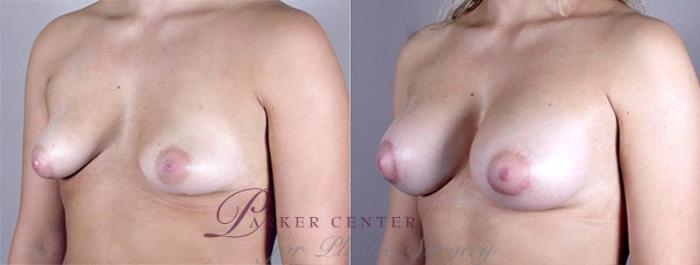 Breast Augmentation Case 373 Before & After View #2 | Paramus, NJ | Parker Center for Plastic Surgery