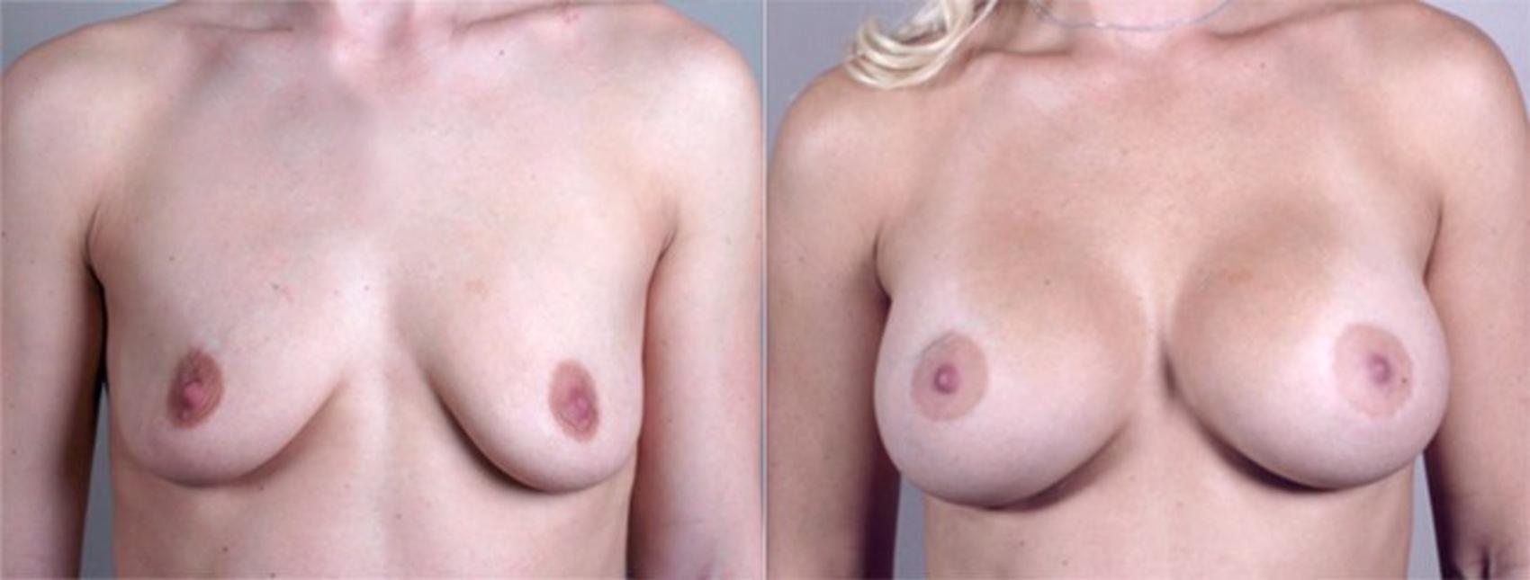 Breast Augmentation Case 374 Before & After View #1 | Paramus, NJ | Parker Center for Plastic Surgery