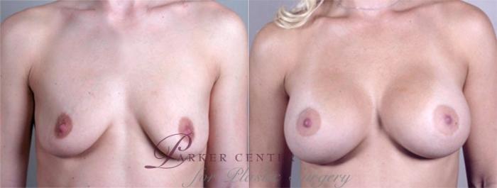 Breast Augmentation Case 374 Before & After View #1 | Paramus, NJ | Parker Center for Plastic Surgery