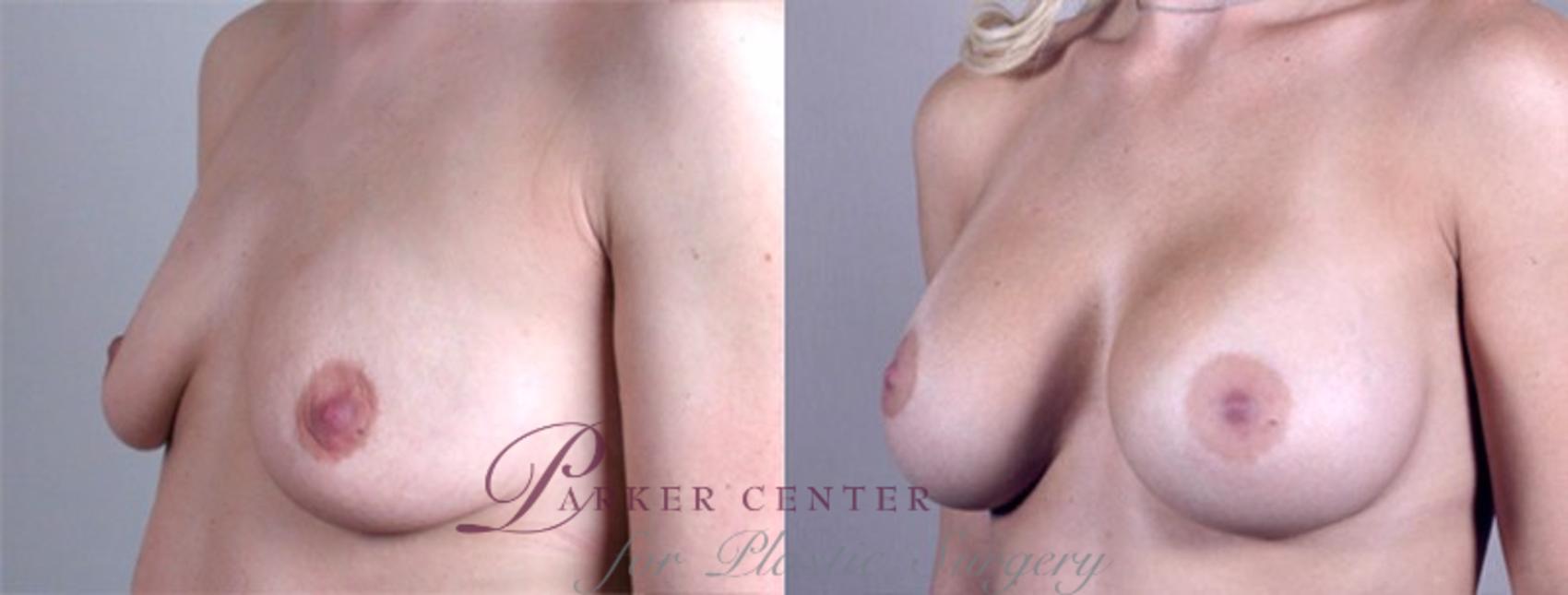 Breast Augmentation Case 374 Before & After View #2 | Paramus, NJ | Parker Center for Plastic Surgery