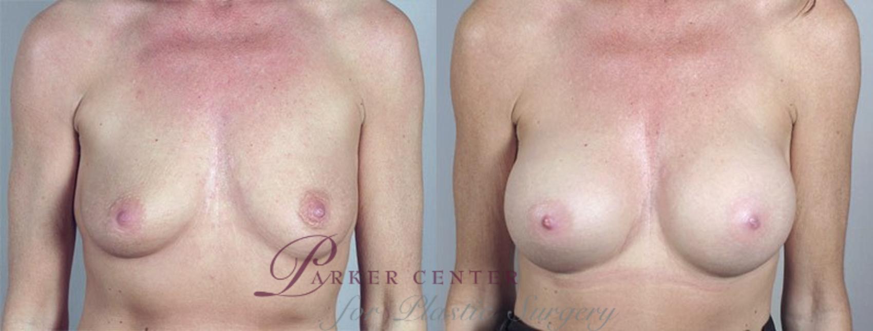 Breast Augmentation Case 375 Before & After View #1 | Paramus, New Jersey | Parker Center for Plastic Surgery