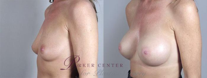Breast Augmentation Case 375 Before & After View #2 | Paramus, New Jersey | Parker Center for Plastic Surgery