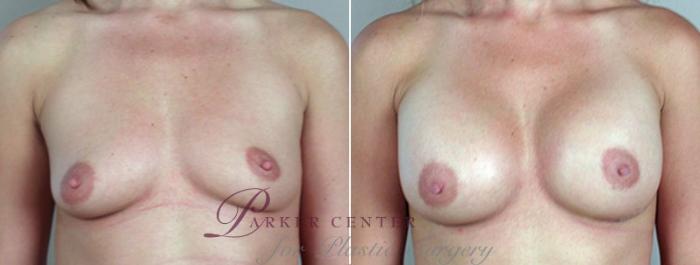 Breast Augmentation Case 377 Before & After View #1 | Paramus, NJ | Parker Center for Plastic Surgery
