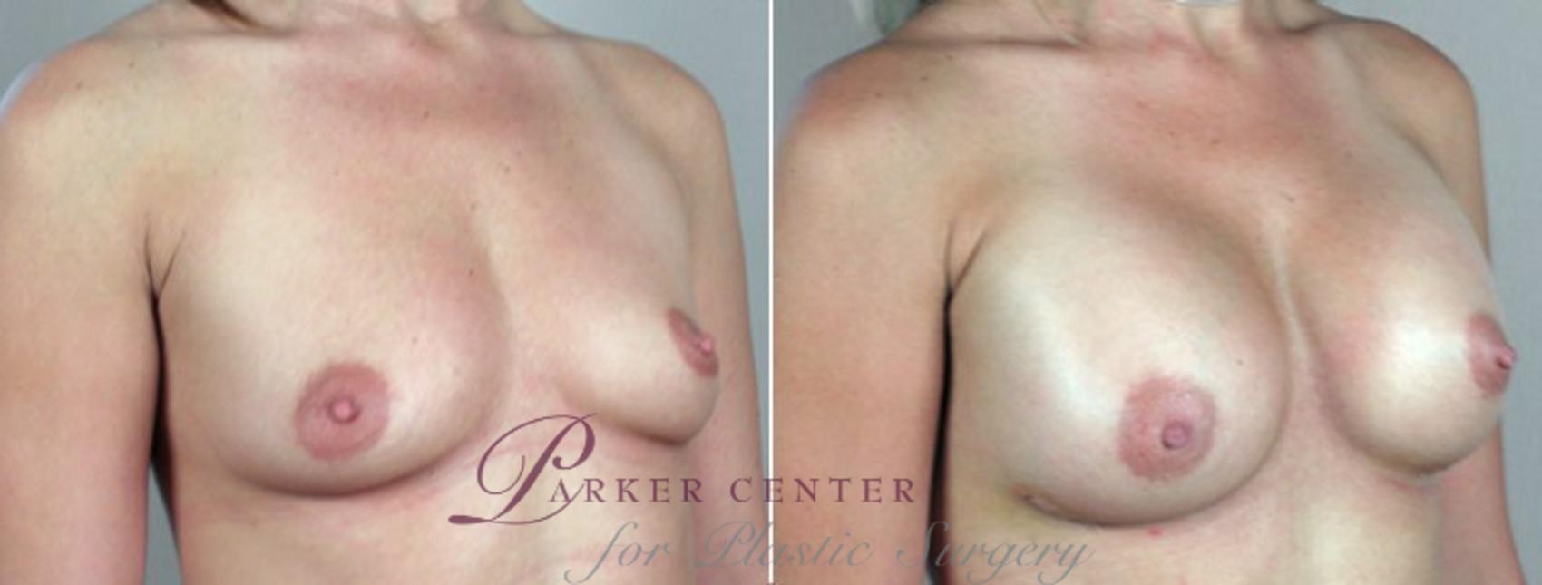 Breast Augmentation Case 377 Before & After View #2 | Paramus, New Jersey | Parker Center for Plastic Surgery