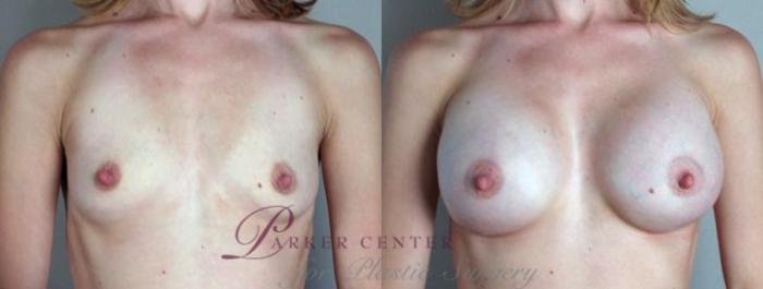 Breast Augmentation Case 378 Before & After View #1 | Paramus, NJ | Parker Center for Plastic Surgery