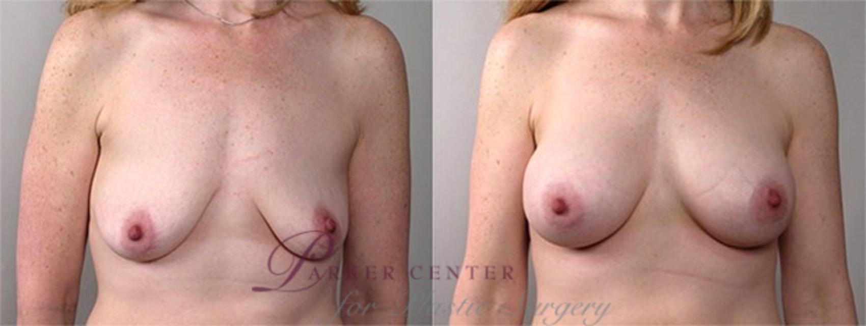 Breast Augmentation Case 379 Before & After View #1 | Paramus, NJ | Parker Center for Plastic Surgery