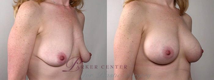 Breast Augmentation Case 379 Before & After View #2 | Paramus, NJ | Parker Center for Plastic Surgery
