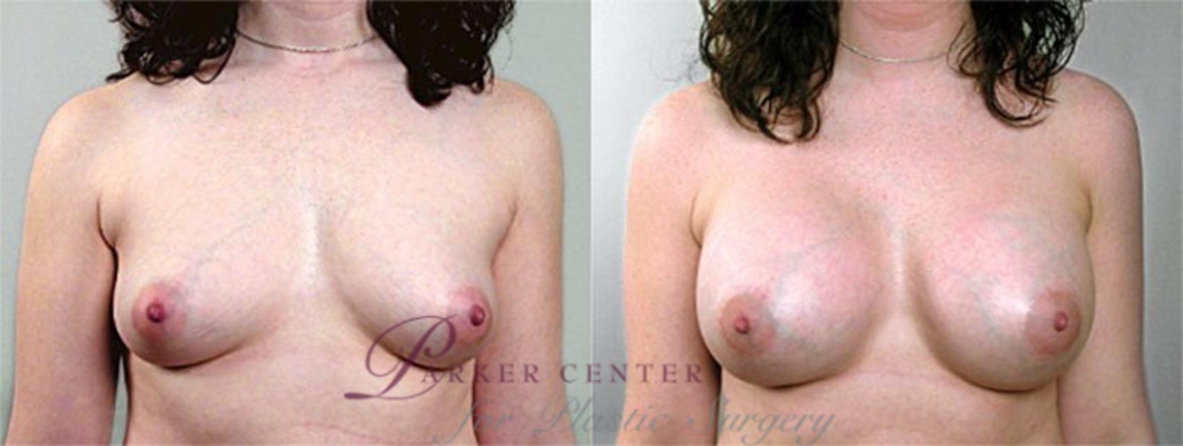 Breast Augmentation Case 380 Before & After View #1 | Paramus, NJ | Parker Center for Plastic Surgery