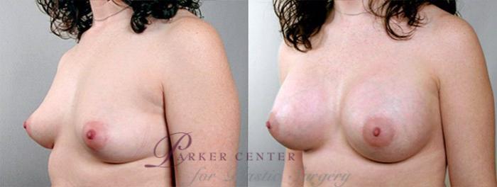Breast Augmentation Case 380 Before & After View #2 | Paramus, NJ | Parker Center for Plastic Surgery