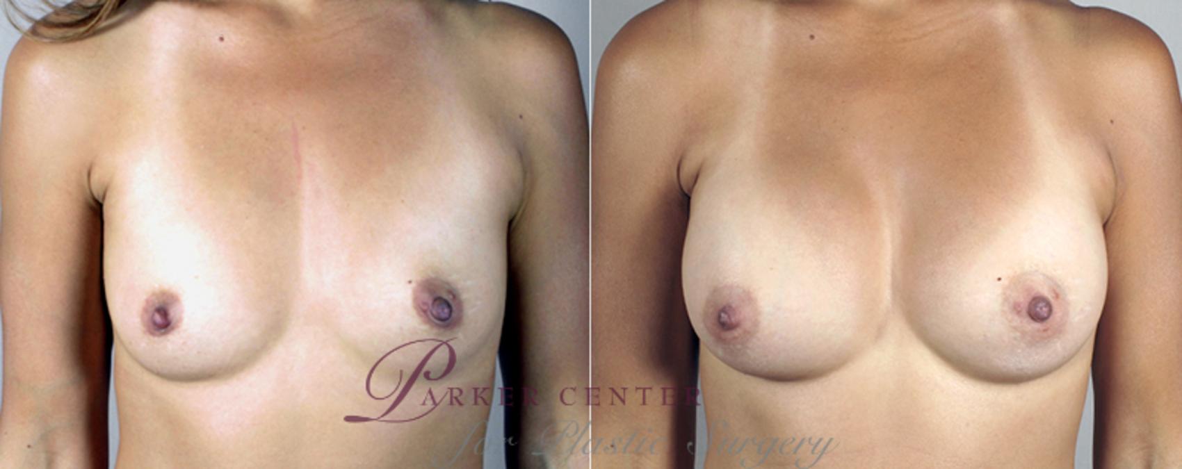 Breast Asymmetry Case 382 Before & After View #1 | Paramus, NJ | Parker Center for Plastic Surgery