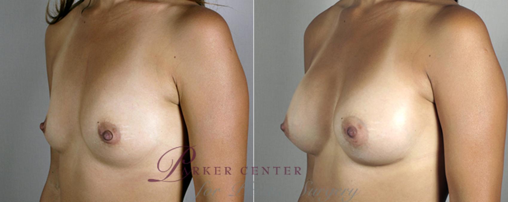 Breast Asymmetry Case 382 Before & After View #2 | Paramus, NJ | Parker Center for Plastic Surgery