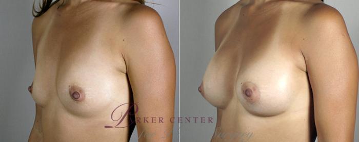 Breast Augmentation Case 382 Before & After View #2 | Paramus, NJ | Parker Center for Plastic Surgery