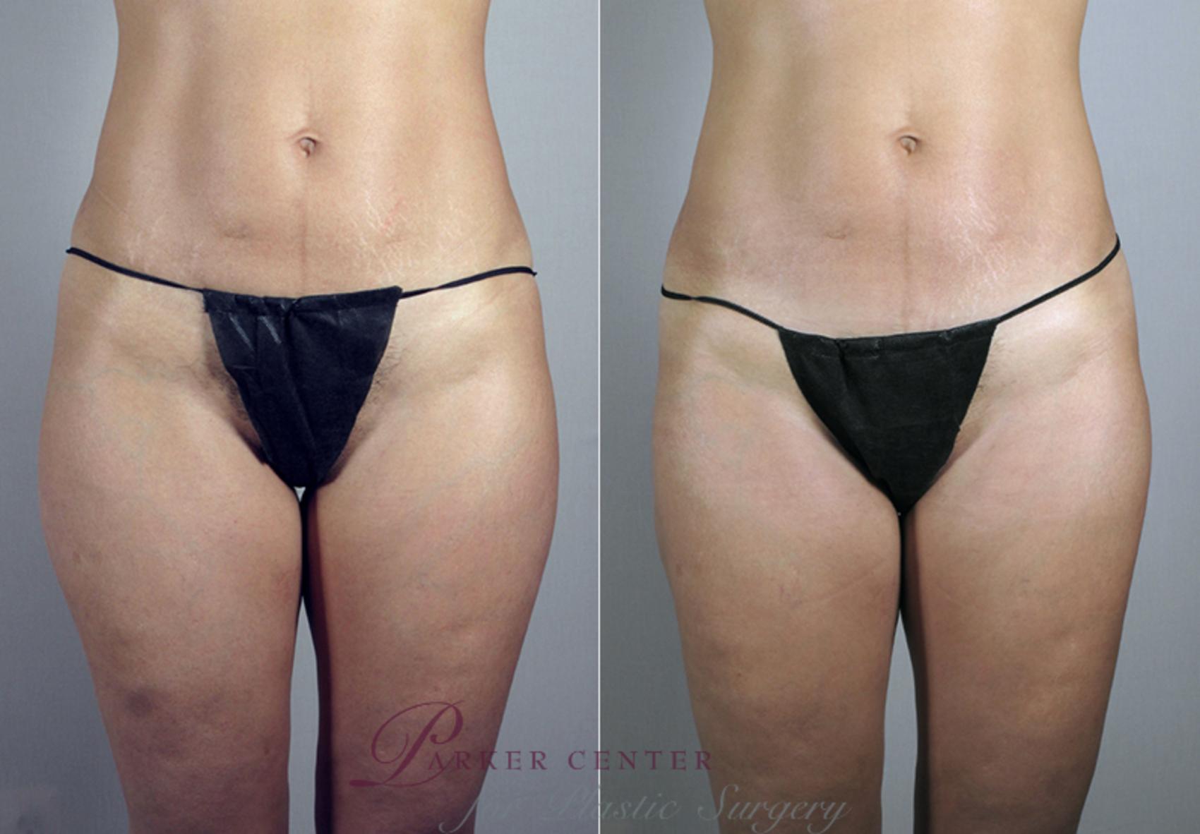 Breast Asymmetry Case 382 Before & After View #3 | Paramus, NJ | Parker Center for Plastic Surgery