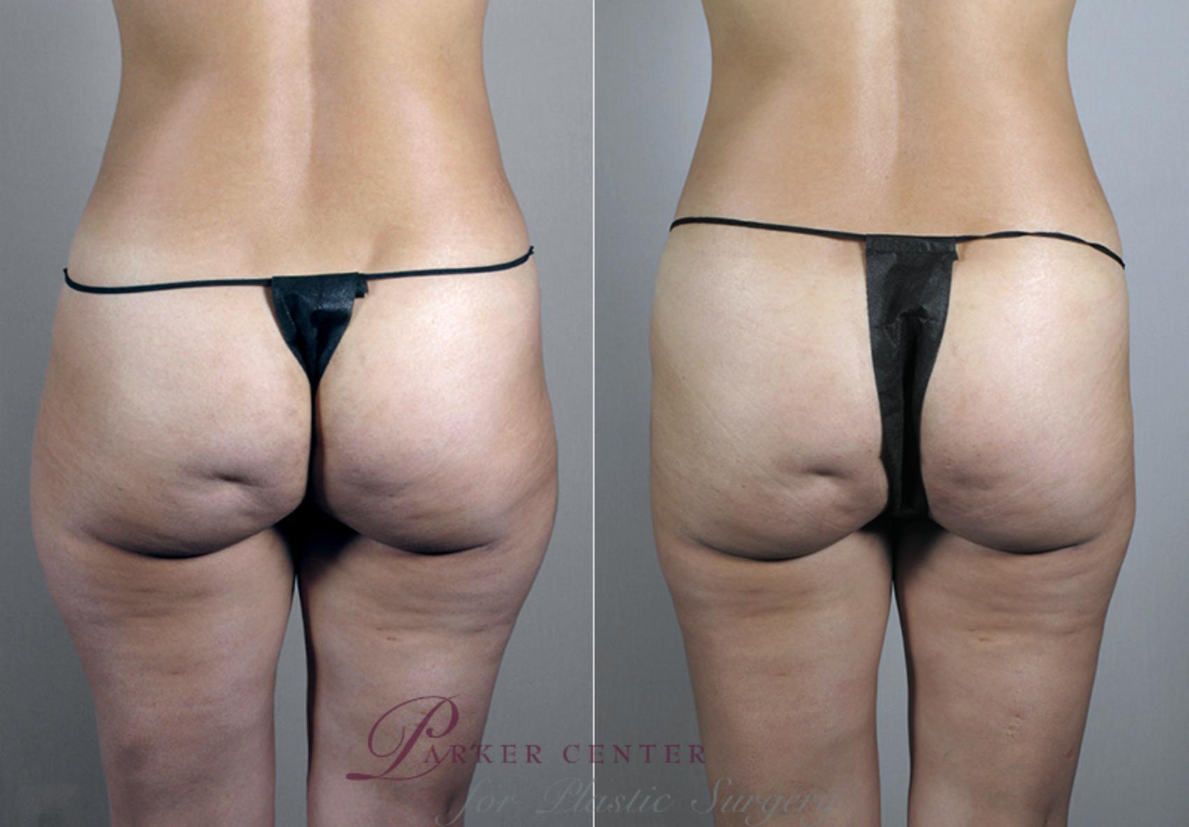Breast Asymmetry Case 382 Before & After View #4 | Paramus, NJ | Parker Center for Plastic Surgery