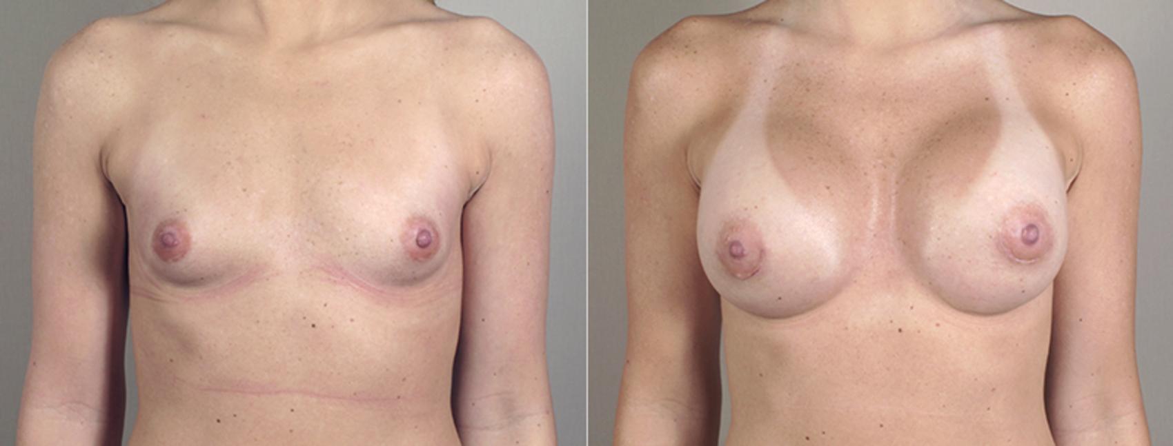 Breast Augmentation Case 385 Before & After View #1 | Paramus, NJ | Parker Center for Plastic Surgery