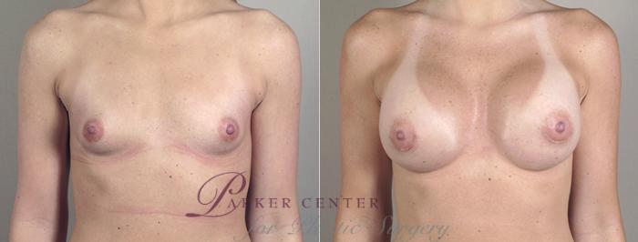 Breast Augmentation Case 385 Before & After View #1 | Paramus, NJ | Parker Center for Plastic Surgery