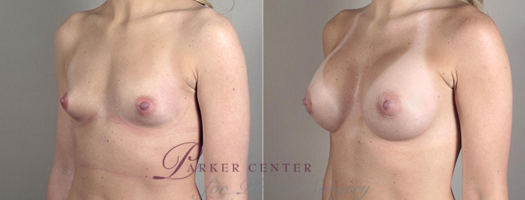 Breast Augmentation Case 385 Before & After View #2 | Paramus, NJ | Parker Center for Plastic Surgery