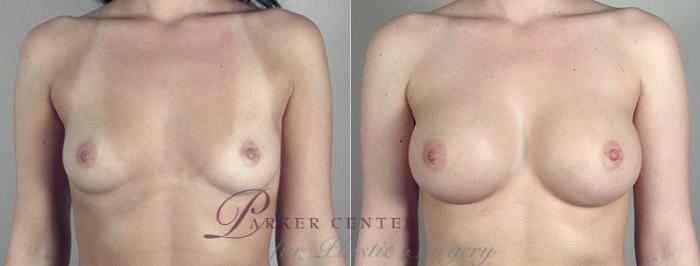 Breast Augmentation Case 386 Before & After View #1 | Paramus, NJ | Parker Center for Plastic Surgery