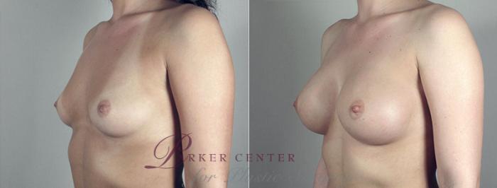 Breast Augmentation Case 386 Before & After View #2 | Paramus, NJ | Parker Center for Plastic Surgery