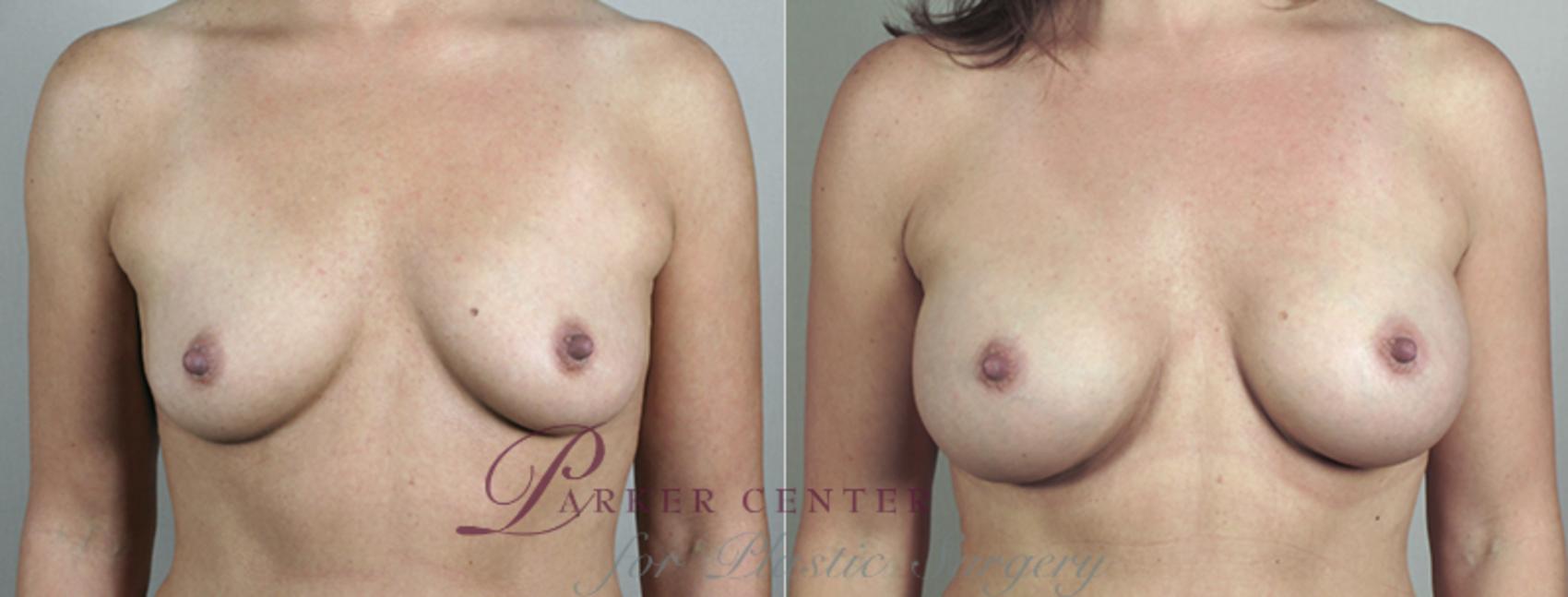 Breast Augmentation Case 387 Before & After View #1 | Paramus, NJ | Parker Center for Plastic Surgery