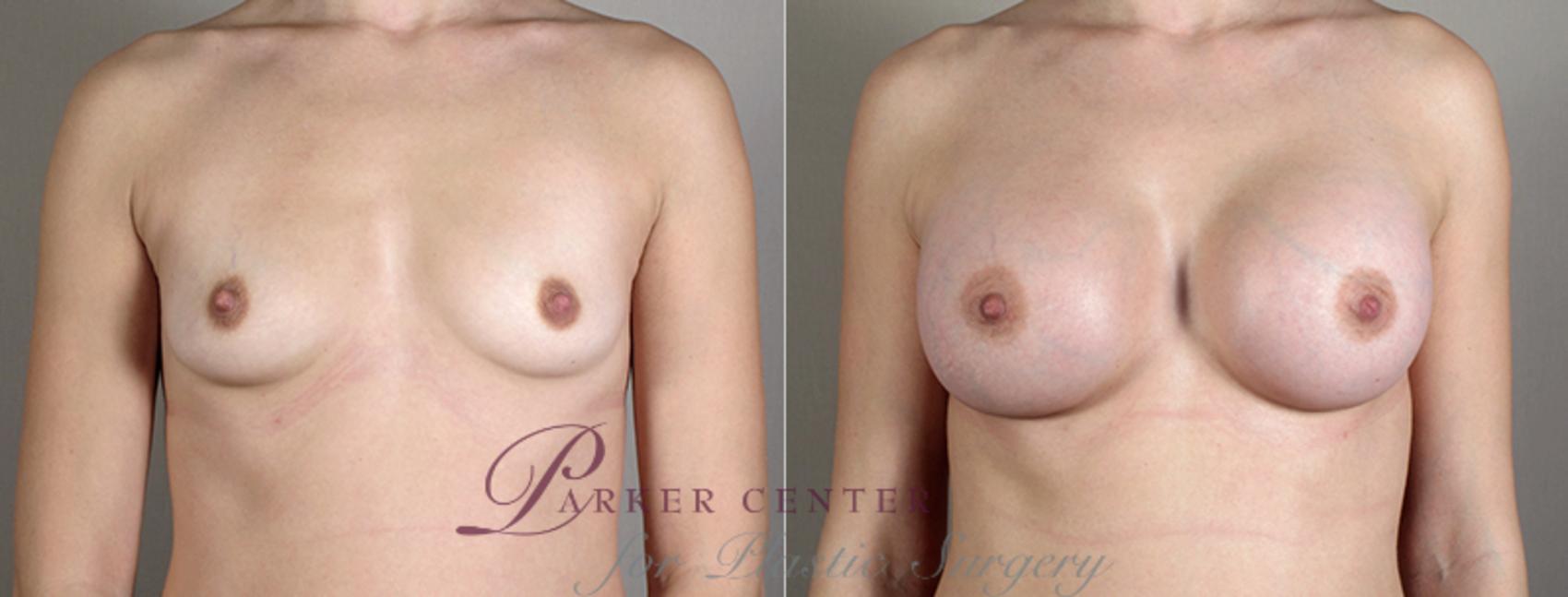 Breast Augmentation Case 389 Before & After View #1 | Paramus, NJ | Parker Center for Plastic Surgery