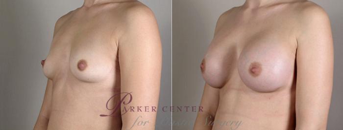 Breast Augmentation Case 389 Before & After View #2 | Paramus, NJ | Parker Center for Plastic Surgery