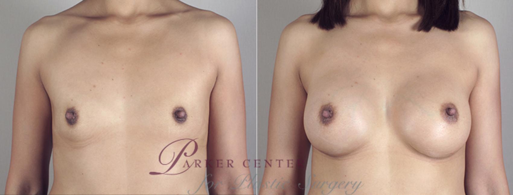 Breast Augmentation Case 390 Before & After View #1 | Paramus, NJ | Parker Center for Plastic Surgery