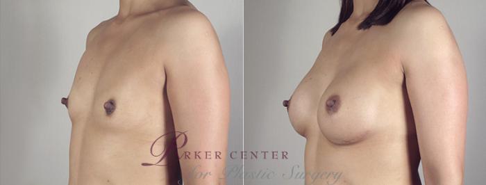 Breast Augmentation Case 390 Before & After View #2 | Paramus, NJ | Parker Center for Plastic Surgery