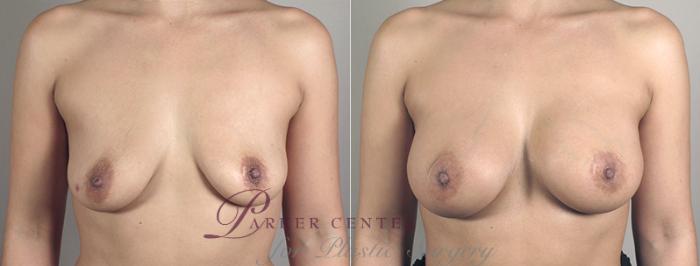Breast Augmentation Case 391 Before & After View #1 | Paramus, NJ | Parker Center for Plastic Surgery