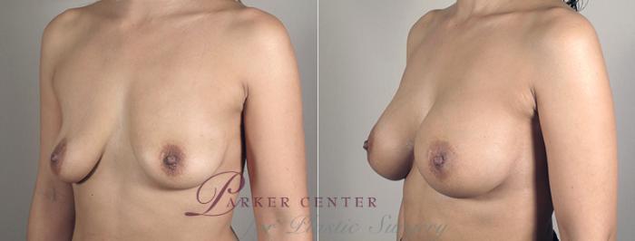 Breast Augmentation Case 391 Before & After View #2 | Paramus, NJ | Parker Center for Plastic Surgery