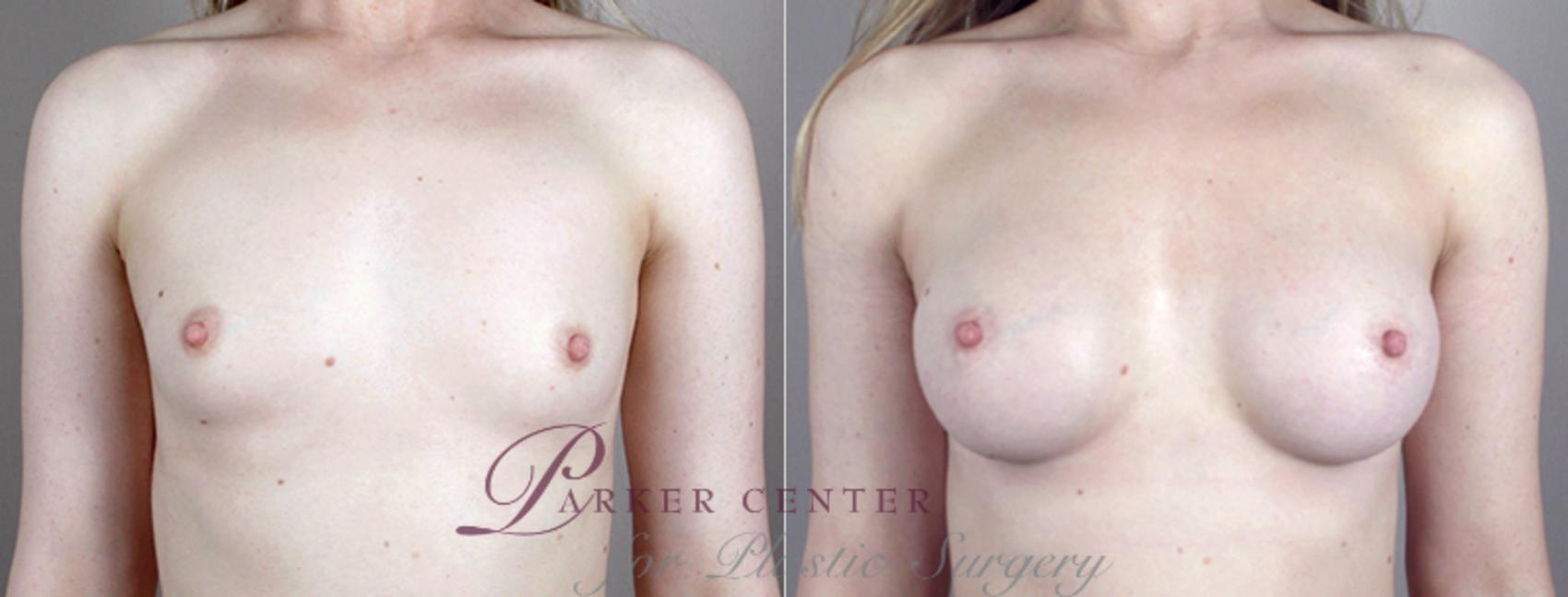 Breast Augmentation Case 392 Before & After View #1 | Paramus, NJ | Parker Center for Plastic Surgery
