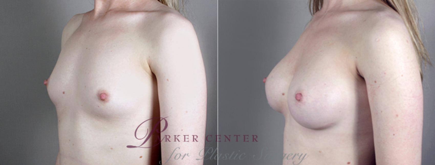 Breast Augmentation Case 392 Before & After View #2 | Paramus, New Jersey | Parker Center for Plastic Surgery
