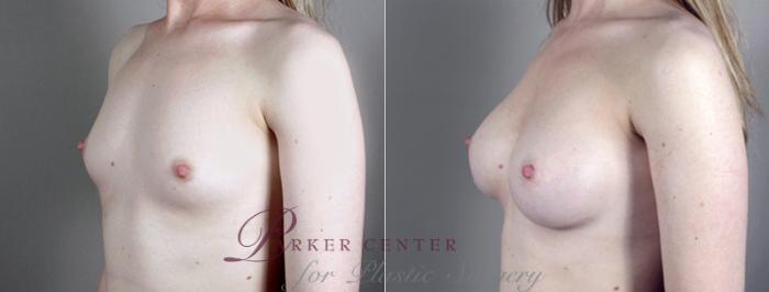 Breast Augmentation Case 392 Before & After View #2 | Paramus, NJ | Parker Center for Plastic Surgery