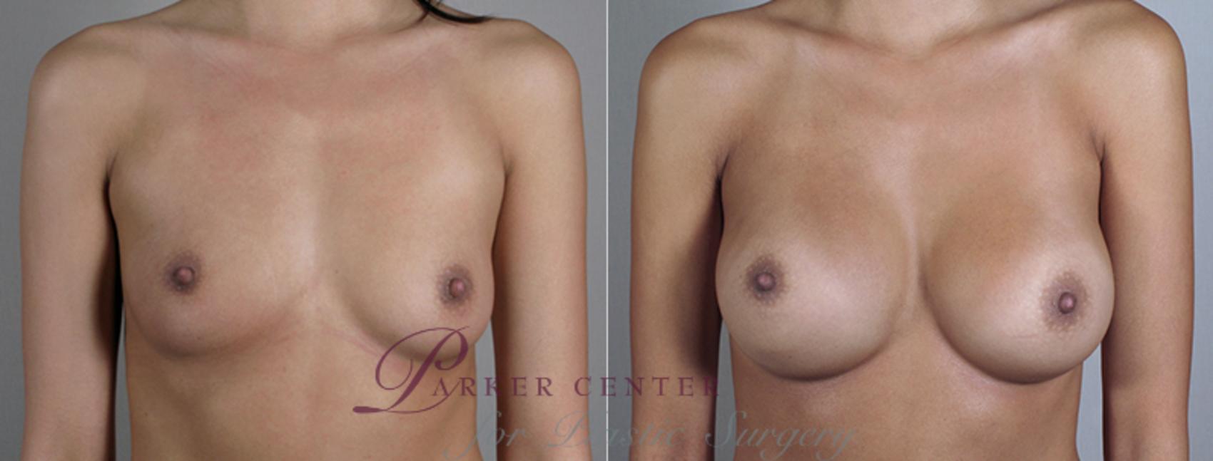 Breast Augmentation Case 393 Before & After View #1 | Paramus, NJ | Parker Center for Plastic Surgery