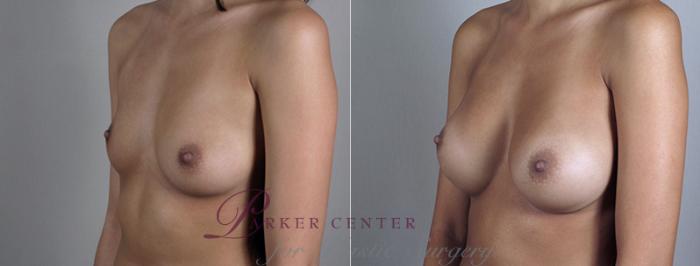 Breast Augmentation Case 393 Before & After View #2 | Paramus, NJ | Parker Center for Plastic Surgery