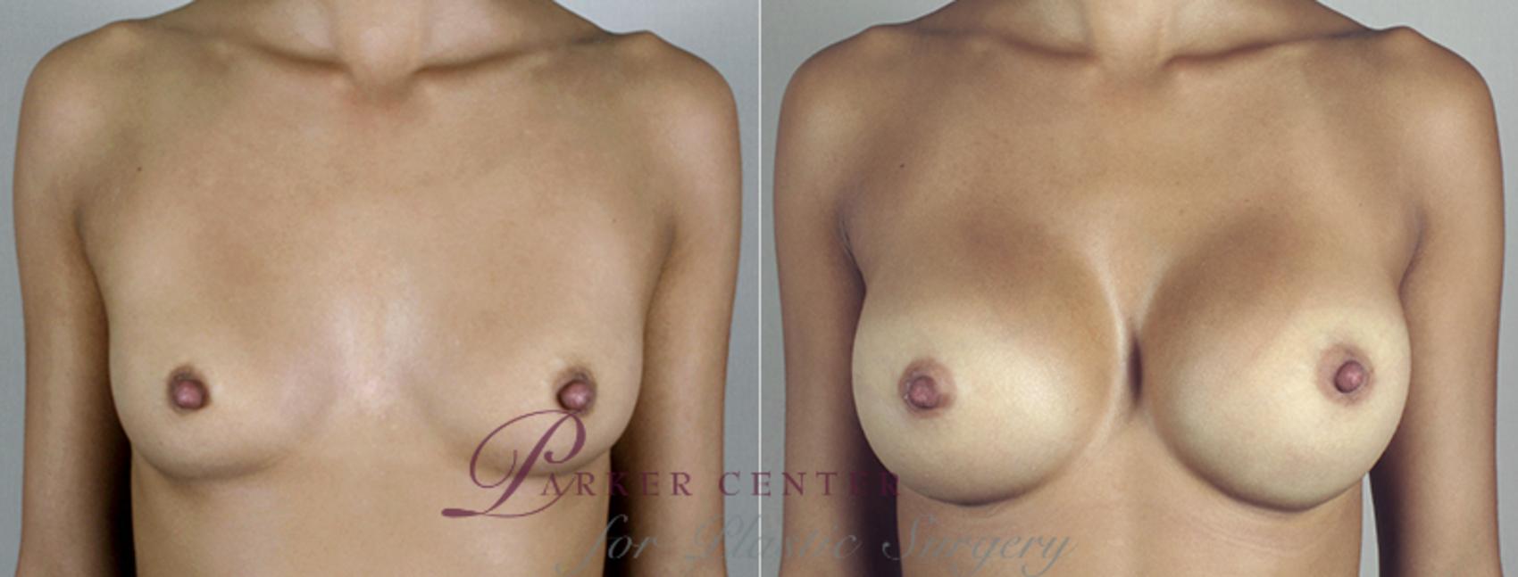 Breast Augmentation Case 394 Before & After View #1 | Paramus, NJ | Parker Center for Plastic Surgery