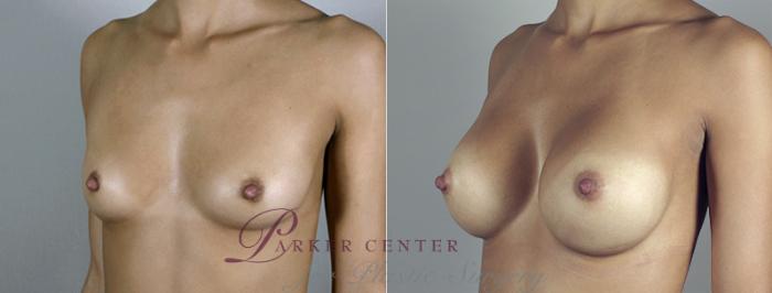 Breast Augmentation Case 394 Before & After View #2 | Paramus, NJ | Parker Center for Plastic Surgery