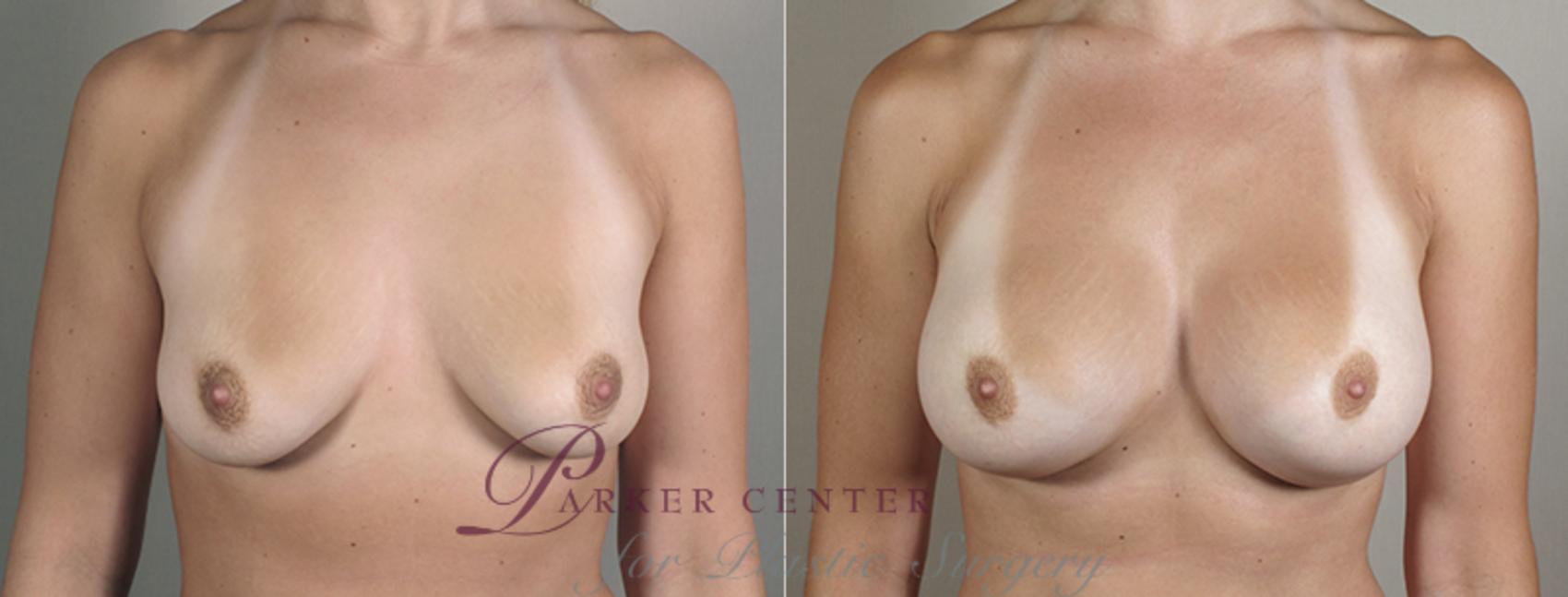 Breast Augmentation Case 395 Before & After View #1 | Paramus, NJ | Parker Center for Plastic Surgery