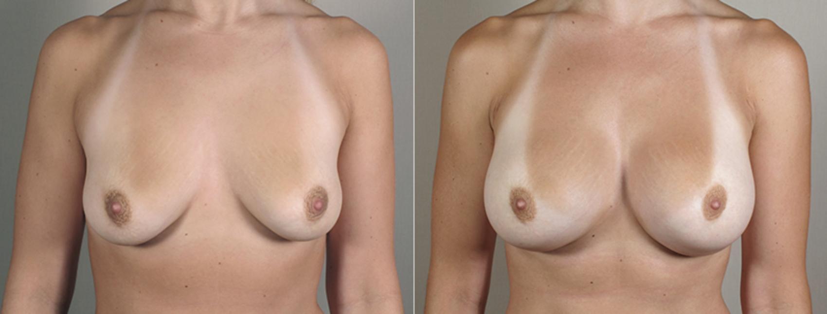 Breast Augmentation Case 395 Before & After View #1 | Paramus, New Jersey | Parker Center for Plastic Surgery