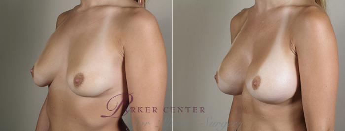 Breast Augmentation Case 395 Before & After View #2 | Paramus, NJ | Parker Center for Plastic Surgery